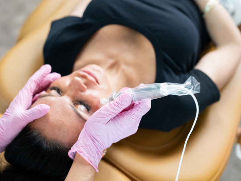 Microneedling at Anacortes Health & Aesthetics